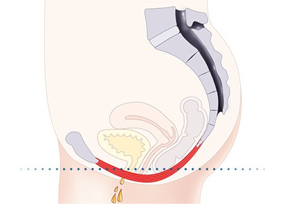 Pelvic-Floor Muscle Repair 5 Pelvic floor muscles Sunbury-on-Thames