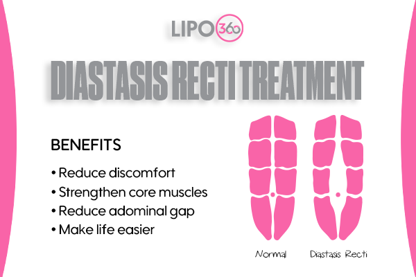 diastasis recti treatment Sunbury-on-Thames