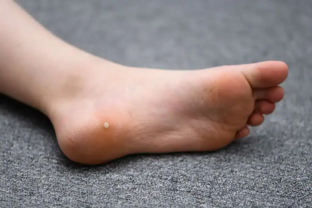 Cryotherapy For Warts And Also Verrucas 2 Image of verruca on the bottom of the foot that able to be treated with Cryotherapy Sunbury-on-Thames