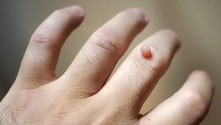 Image of blemish that Cryotherapy Sunbury-on-Thames can remove with Lipo 360.