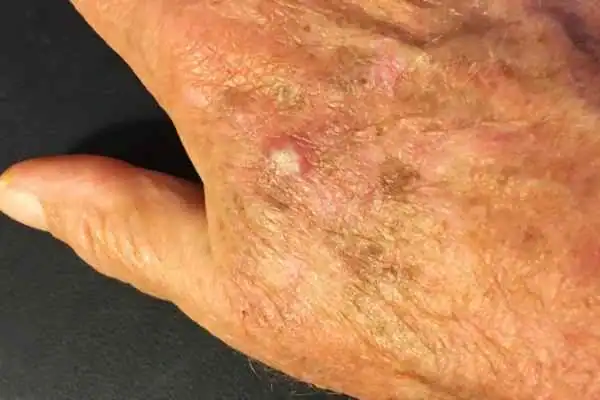 Image of Actinic keratoses Sunbury-on-Thames on a person hand