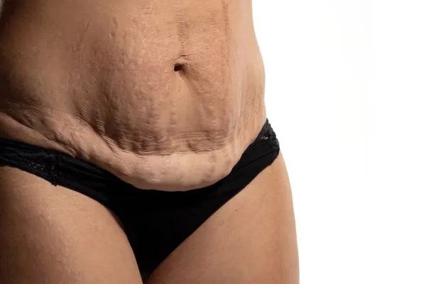 The science behind skin tightening Sunbury-on-Thames picture of a woman's sagging skin on the stomach